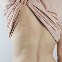 Bed Bug Bites on Back