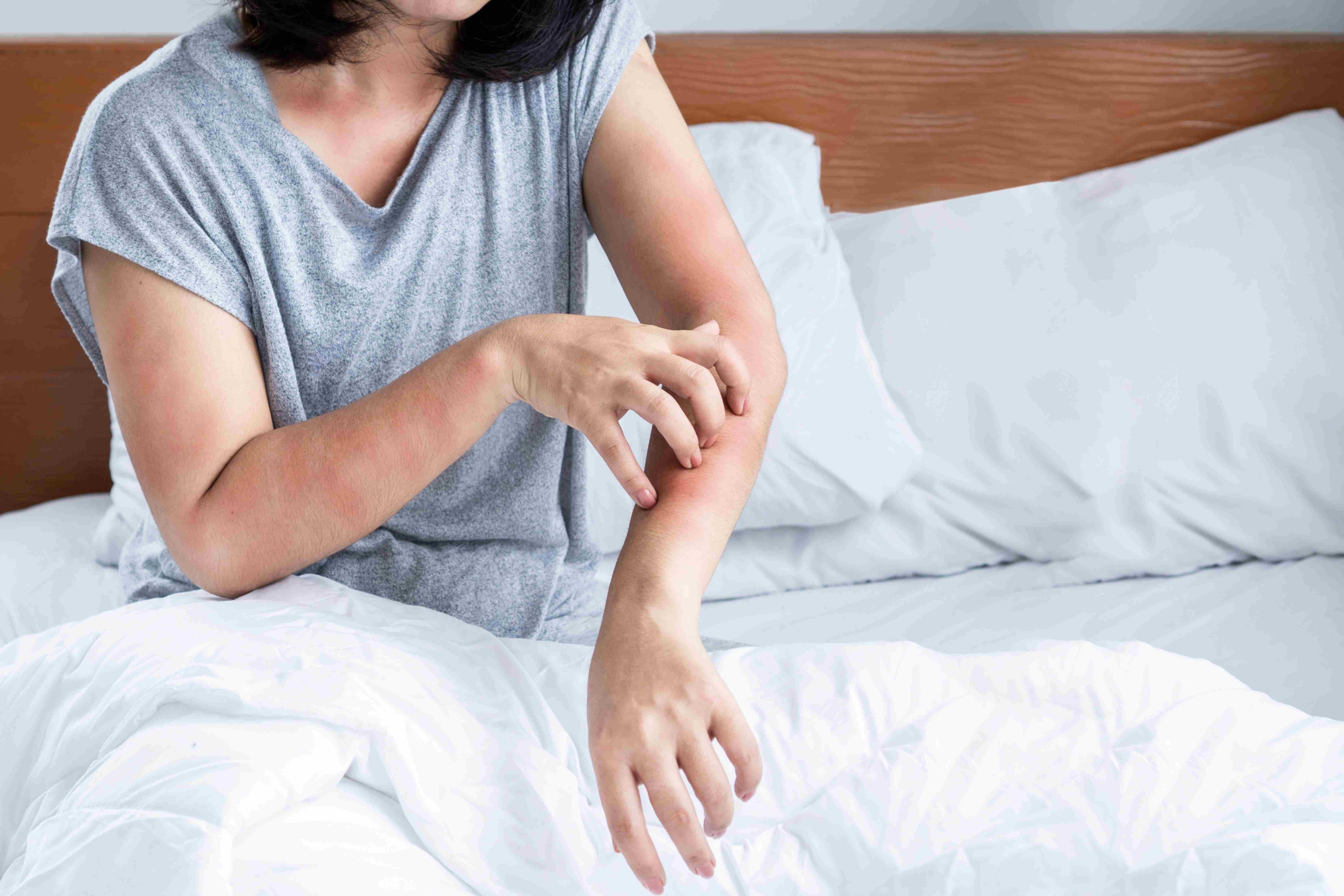 Woman with bed bugs